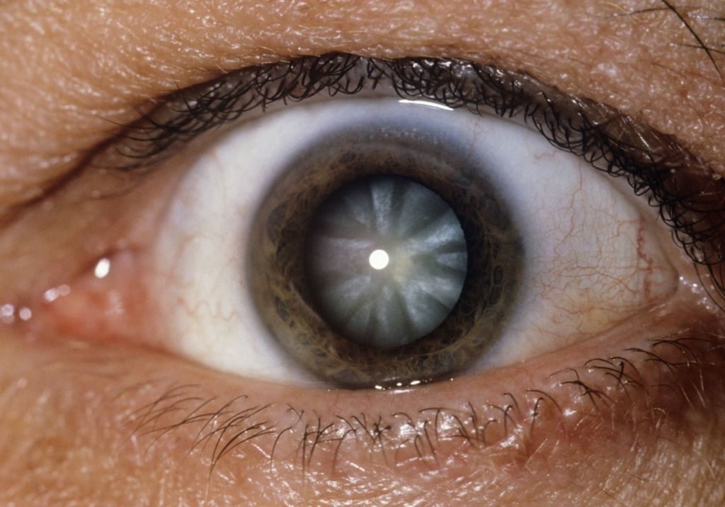 scăderea vederii cu cataractă