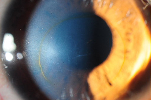 operații de restabilire a vederii pentru keratocon o viziune bună este ceea ce